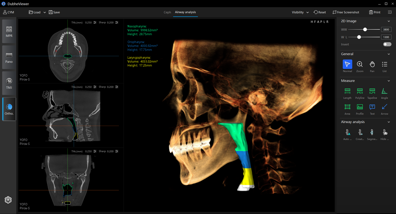 AI airway segmentation