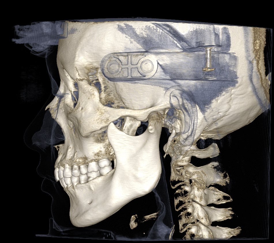 Bone and soft tissue rendering