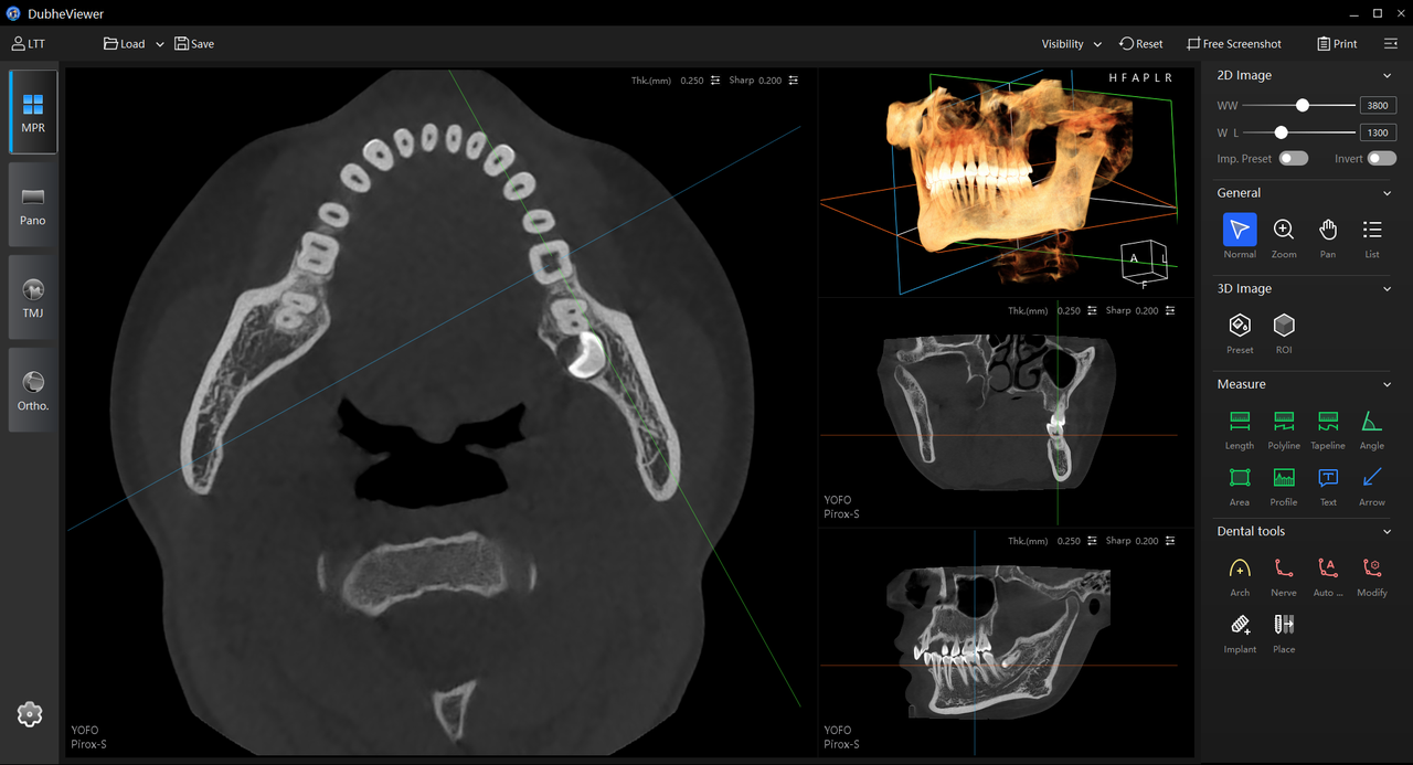 Axial MPR view