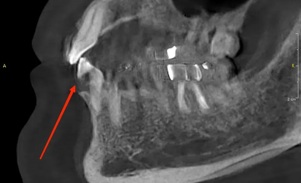 Dental CBCT image showing double contours and ghosting around dental structures caused by motion during acquisition.