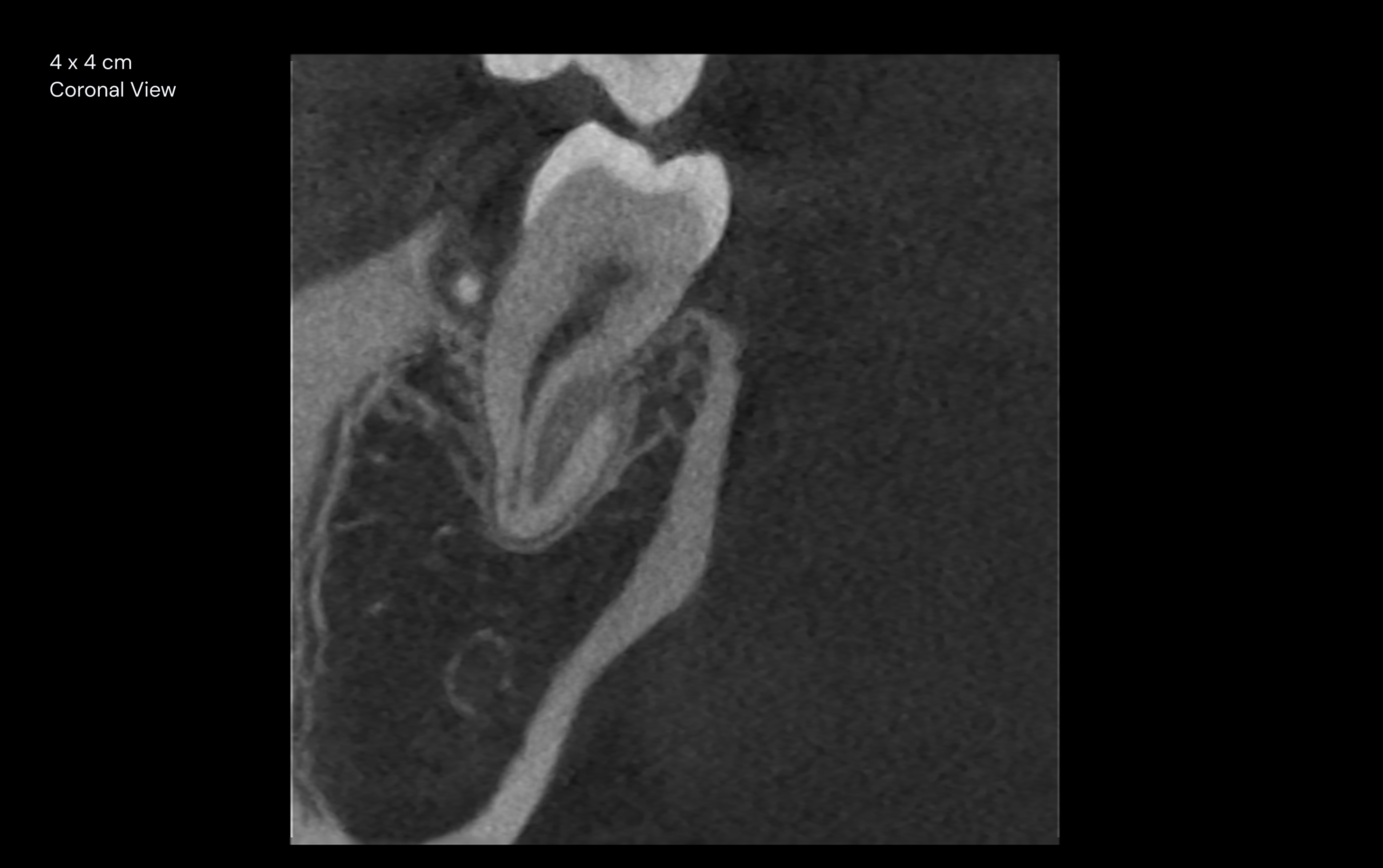 4 x 4 cm Coronal View